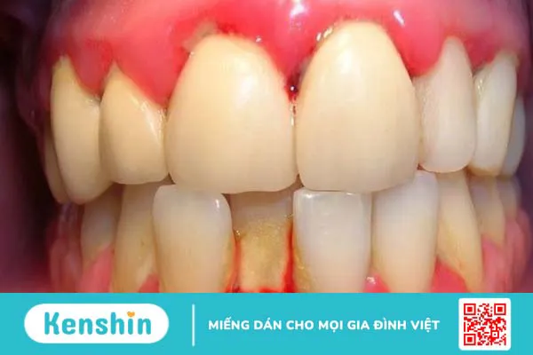 17 cách chữa viêm lợi tại nhà nhanh nhất, an toàn, hiệu quả