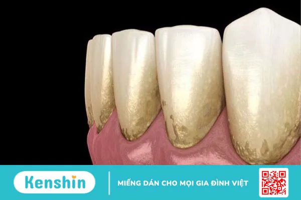 17 cách chữa viêm lợi tại nhà nhanh nhất, an toàn, hiệu quả