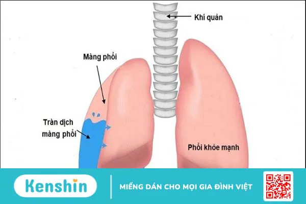 17 nguyên nhân tràn dịch màng phổi nhất định bạn cần lưu tâm