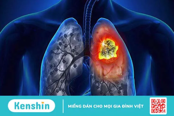 17 nguyên nhân tràn dịch màng phổi nhất định bạn cần lưu tâm