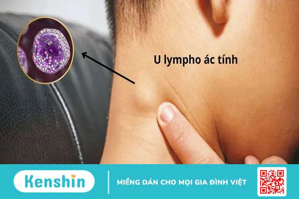 17 nguyên nhân tràn dịch màng phổi nhất định bạn cần lưu tâm