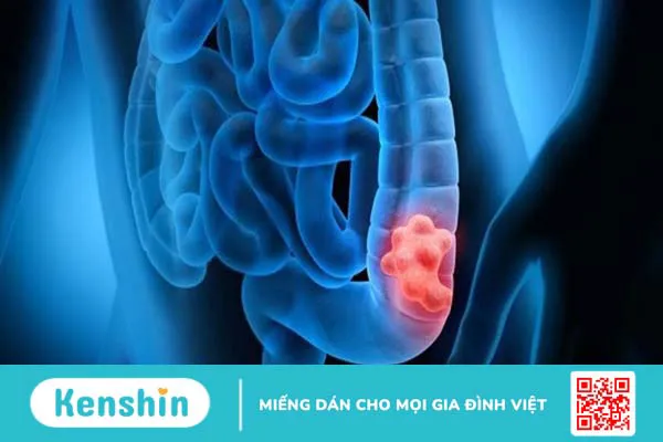 17 nguyên nhân tràn dịch màng phổi nhất định bạn cần lưu tâm