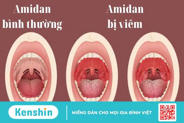 20 cách trị viêm amidan tại nhà an toàn, hiệu quả cao