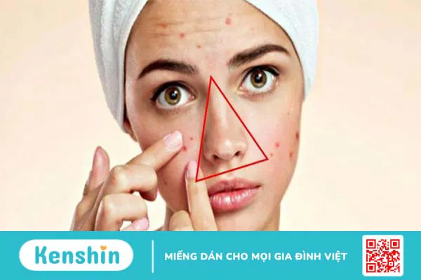 23 cách trị mụn trứng cá tại nhà an toàn, hiệu quả trong thời gian ngắn