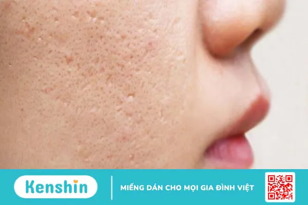 23 cách trị sẹo mụn tại nhà, an toàn đơn giản giúp da mịn màng hơn