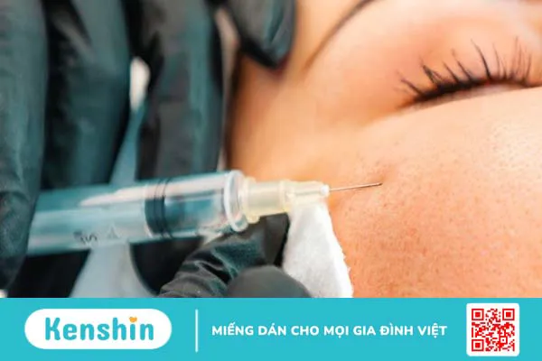 23 cách trị sẹo mụn tại nhà, an toàn đơn giản giúp da mịn màng hơn