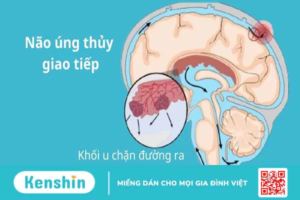 3 biến chứng não úng thuỷ thường gặp, cách điều trị và phòng ngừa