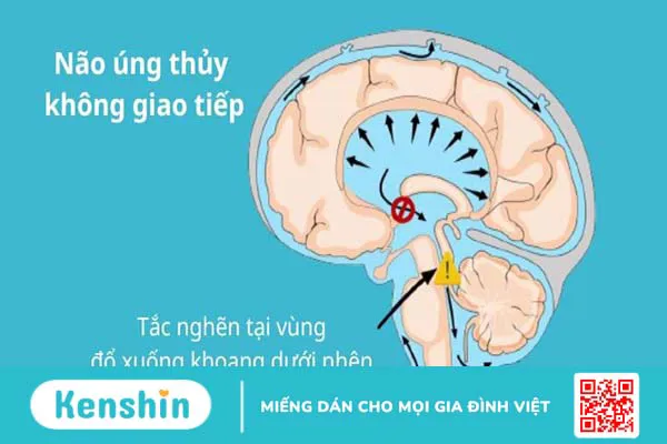 3 biến chứng não úng thuỷ thường gặp, cách điều trị và phòng ngừa