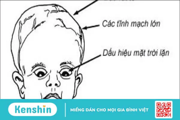 3 biến chứng não úng thuỷ thường gặp, cách điều trị và phòng ngừa