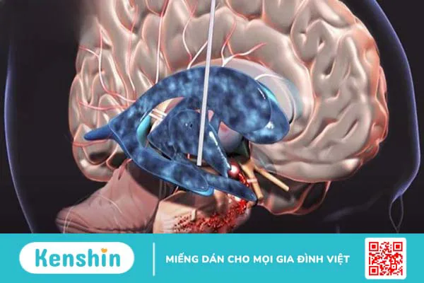 3 biến chứng não úng thuỷ thường gặp, cách điều trị và phòng ngừa