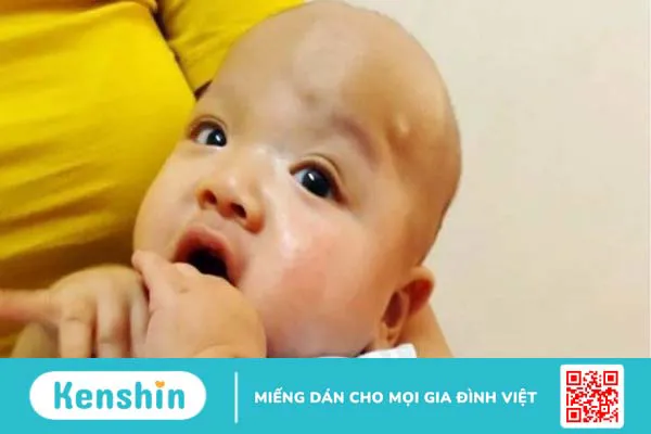 3 biến chứng não úng thuỷ thường gặp, cách điều trị và phòng ngừa