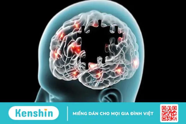 3 biến chứng não úng thuỷ thường gặp, cách điều trị và phòng ngừa