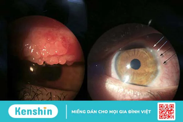 3 nguyên nhân đau mắt đỏ thường gặp và cách phòng ngừa