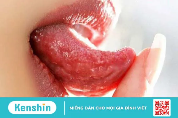 3 nguyên nhân viêm lưỡi thường gặp bạn cần biết