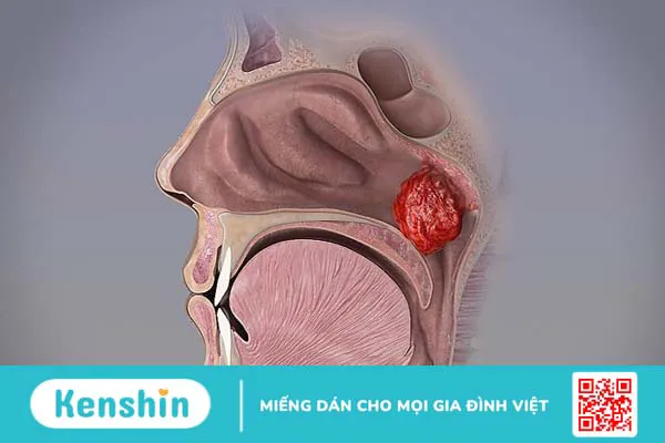 3 nguyên nhân viêm tai giữa có thể bạn chưa biết