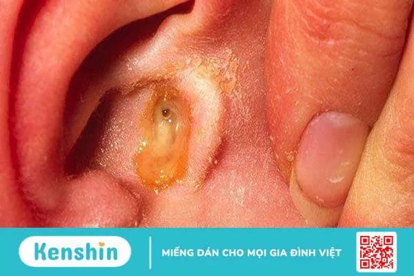 3 nguyên nhân viêm tai giữa có thể bạn chưa biết