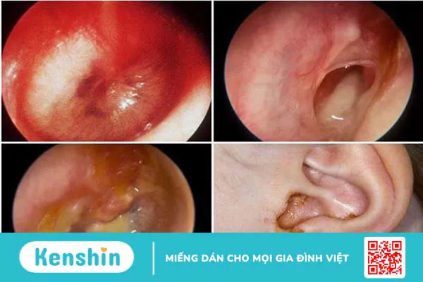 3 nguyên nhân viêm tai giữa có thể bạn chưa biết