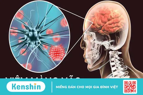 3 triệu chứng viêm màng não thường gặp bạn cần chú ý