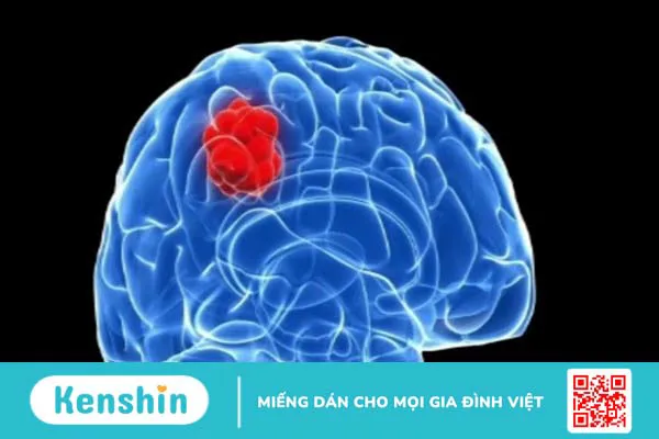 3 triệu chứng viêm màng não thường gặp bạn cần chú ý