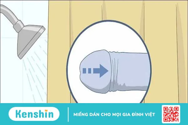 4 cách chữa hẹp bao quy đầu an toàn và hiệu quả nhất