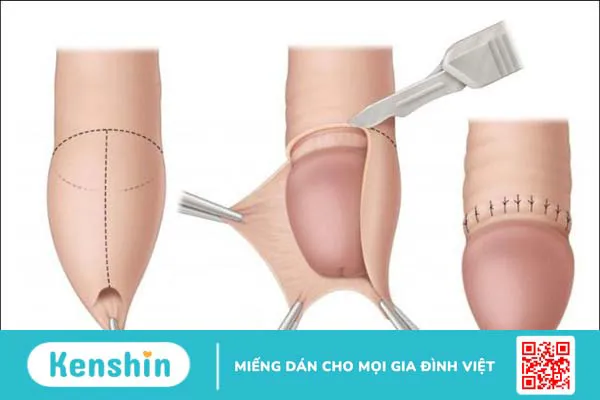 4 cách chữa hẹp bao quy đầu an toàn và hiệu quả nhất