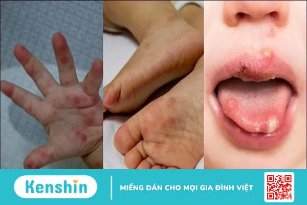 4 cấp độ bệnh tay chân miệng – cấp độ 1 có cần đi bệnh viện không?