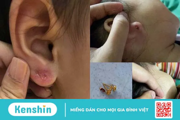 4 dấu hiệu nhiễm trùng khi bấm lỗ tai cần lưu ý kịp thời