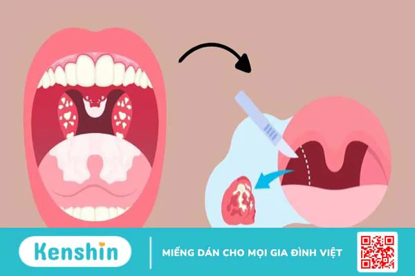 4 lưu ý sau khi cắt amidan và cách đề phòng biến chứng bạn cần biết