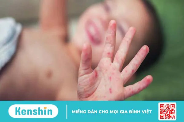 4 mẹo giúp bé hết mút tay các mẹ nên biết