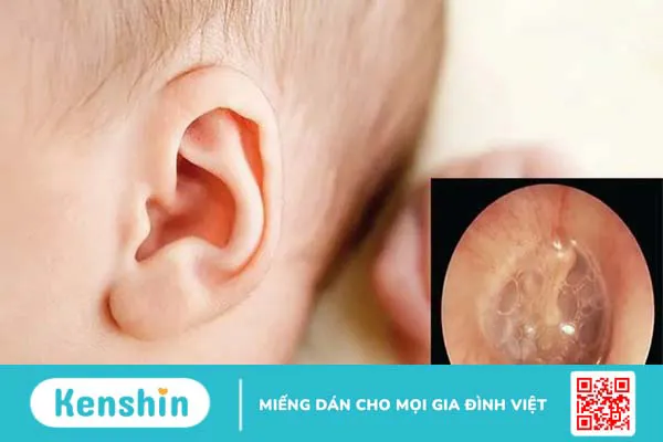 4 nguyên nhân ù tai thường gặp và cách phòng ngừa bệnh ù tai