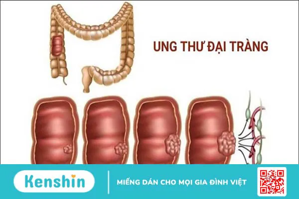 4 phương pháp xét nghiệm tầm soát ung thư đại tràng mà bạn nên biết