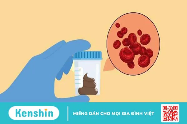 4 phương pháp xét nghiệm tầm soát ung thư đại tràng mà bạn nên biết