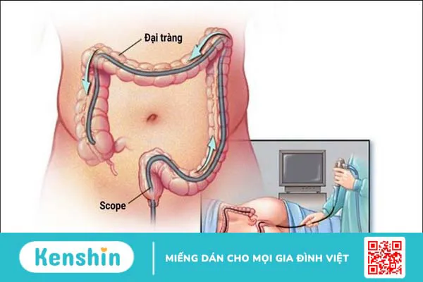 4 phương pháp xét nghiệm tầm soát ung thư đại tràng mà bạn nên biết