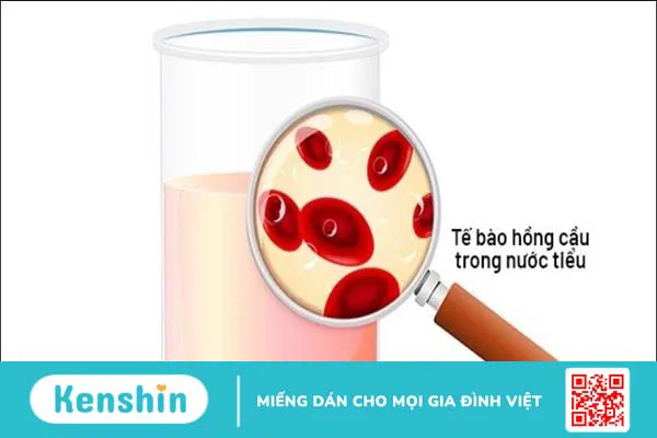 4 triệu chứng viêm đường tiết niệu giúp bạn nhận biết bệnh chính xác