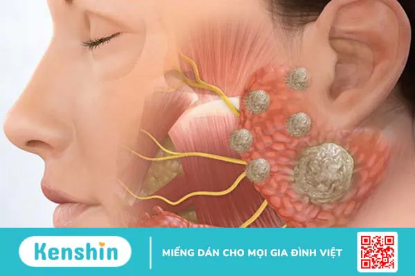 5 cách điều trị quai bị tại nhà đơn giản, hiệu quả giúp bạn nhanh khỏi bệnh