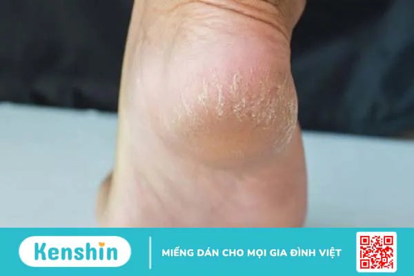 5 cách trị nứt gót chân bằng vaseline tại nhà đơn giản và hiệu quả