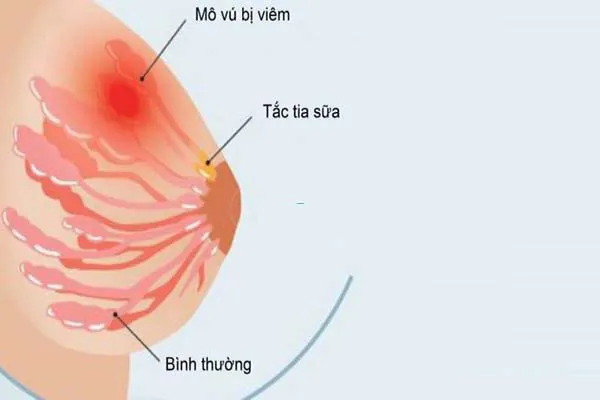 5 dấu hiệu áp xe vú giúp bạn nhận biết bệnh chính xác