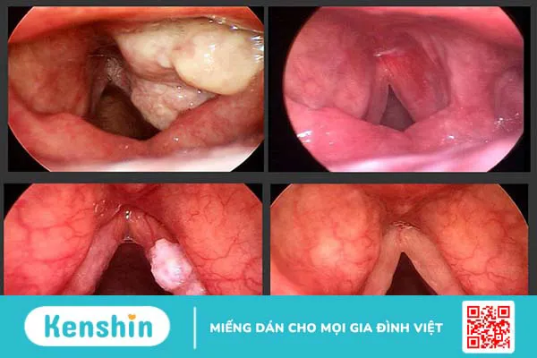 5 dấu hiệu ung thư thanh quản thường thấy giúp bạn nhận biết bệnh sớm