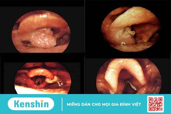 5 dấu hiệu ung thư thanh quản thường thấy giúp bạn nhận biết bệnh sớm