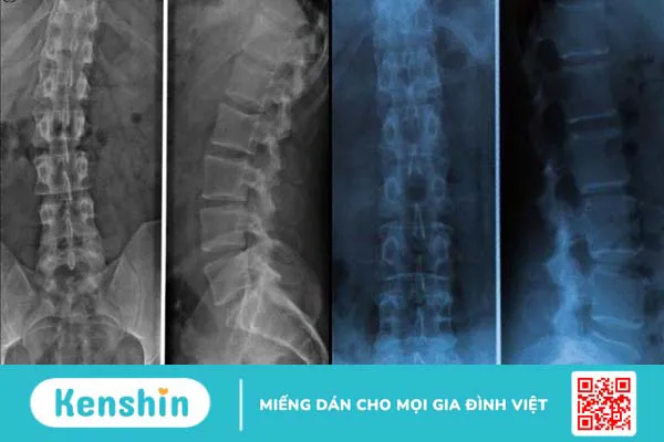 5 triệu chứng đau thần kinh tọa phổ biến không thể xem thường