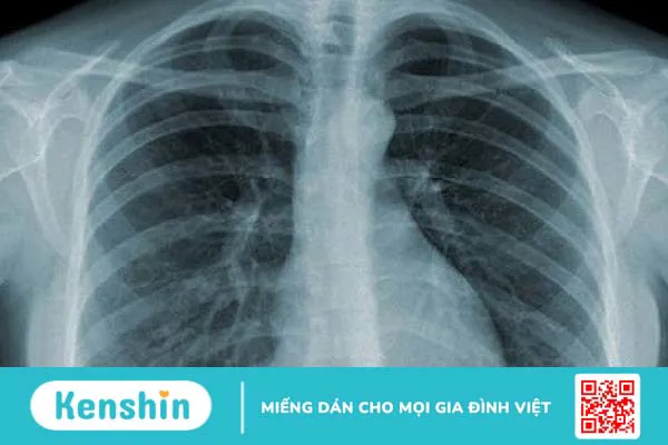 5 triệu chứng lao phổi giúp bạn nhận biết bệnh chính xác