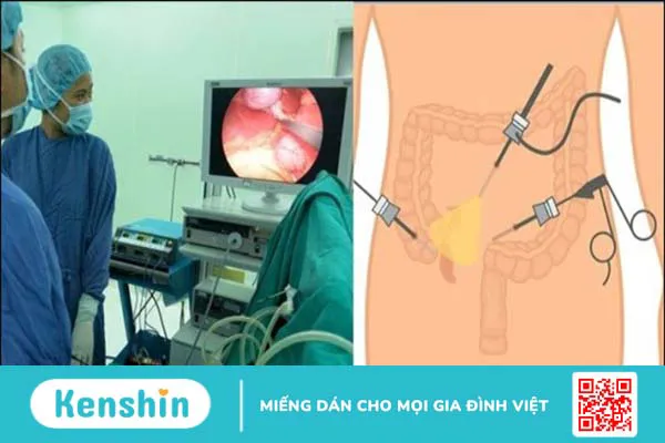 5 triệu chứng và phương pháp điều trị viêm ruột thừa cấp tính nên biết