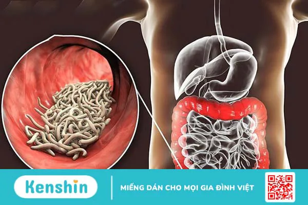 6 bệnh lây qua đường tiêu hoá phổ biến và các nguyên nhân điển hình