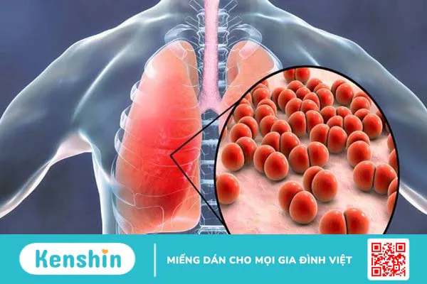 6 cách điều trị hỗ trợ sởi cho trẻ em và hướng dẫn chăm sóc