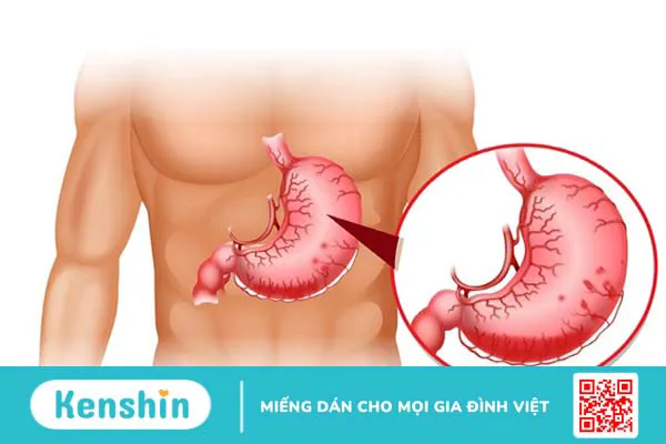 6 công dụng của thuốc Phosphalugel và lưu ý khi sử dụng Phosphalugel