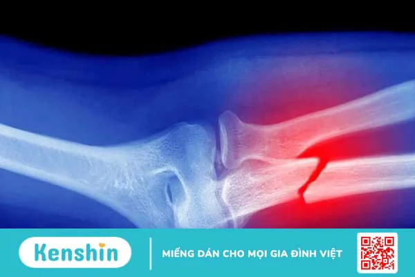 6 dấu hiệu loãng xương bạn không nên bỏ qua