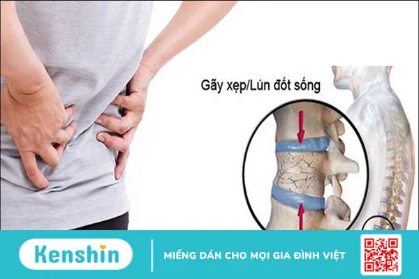 6 dấu hiệu loãng xương bạn không nên bỏ qua