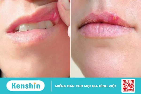 6 dấu hiệu mụn rộp (herpes) sinh dục bạn không thể bỏ qua!