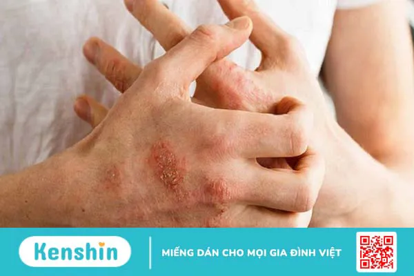 6 dấu hiệu mụn rộp (herpes) sinh dục bạn không thể bỏ qua!