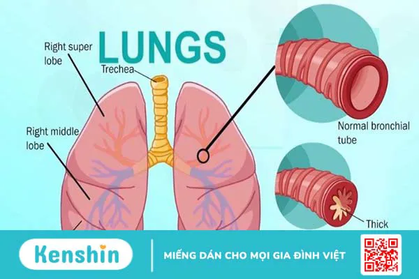 6 lý do bạn còn triệu chứng ho dù đã hết mắc Covid-19